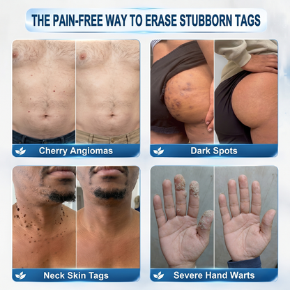 ✨ Official UK Store | Natravor® 7-Day Skin Tag & Blemish Roll-On – Painless & Scar-Free