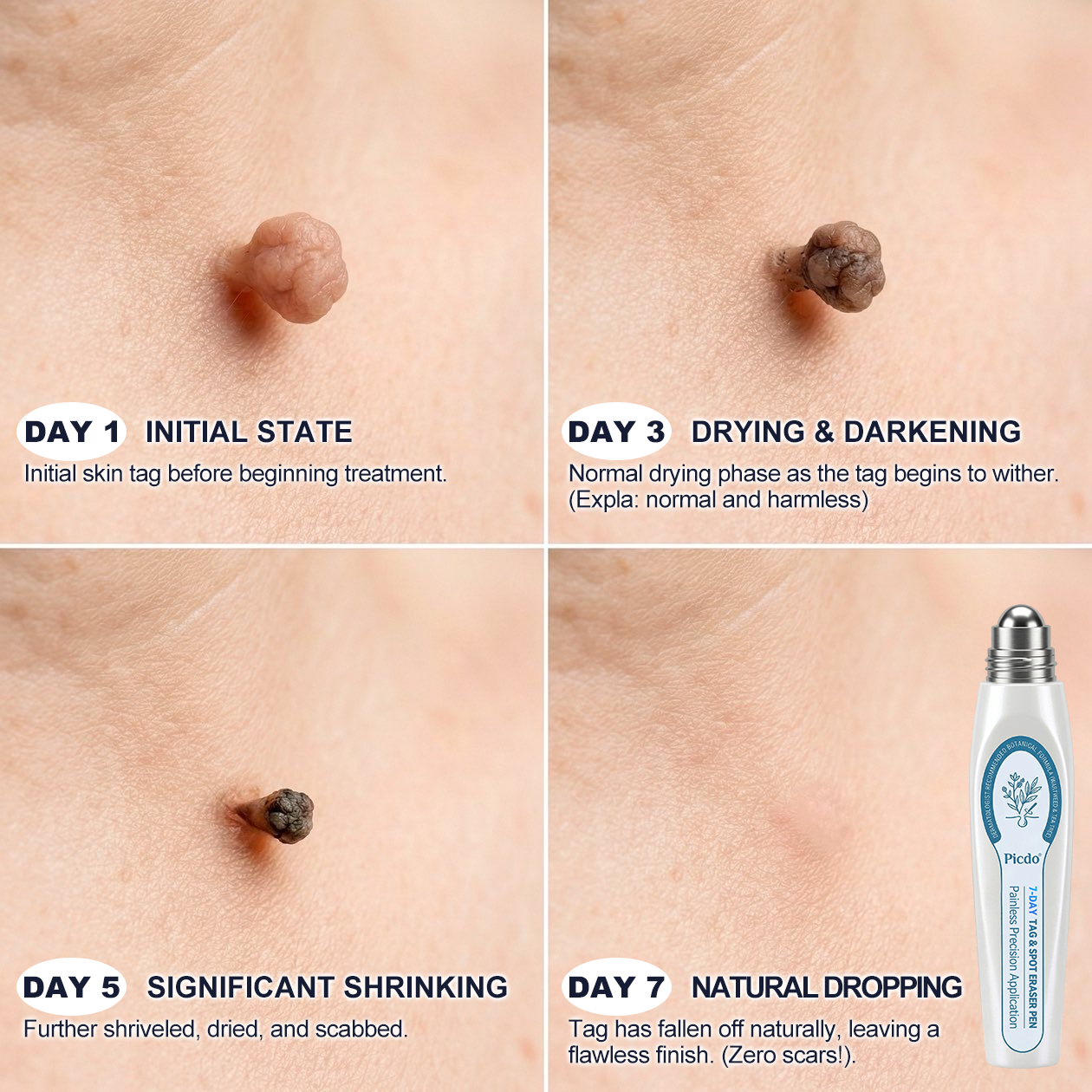 ✨ Official UK Store | Natravor® 7-Day Skin Tag & Blemish Roll-On – Painless & Scar-Free