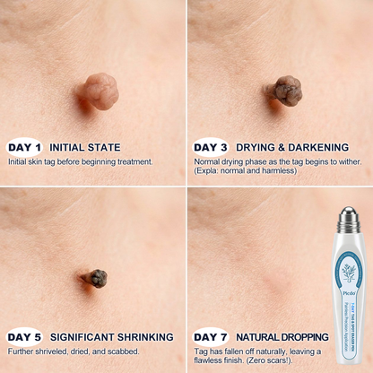 ✨ Official UK Store | Natravor® 7-Day Skin Tag & Blemish Roll-On – Painless & Scar-Free